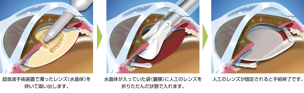 白内障手術の流れ